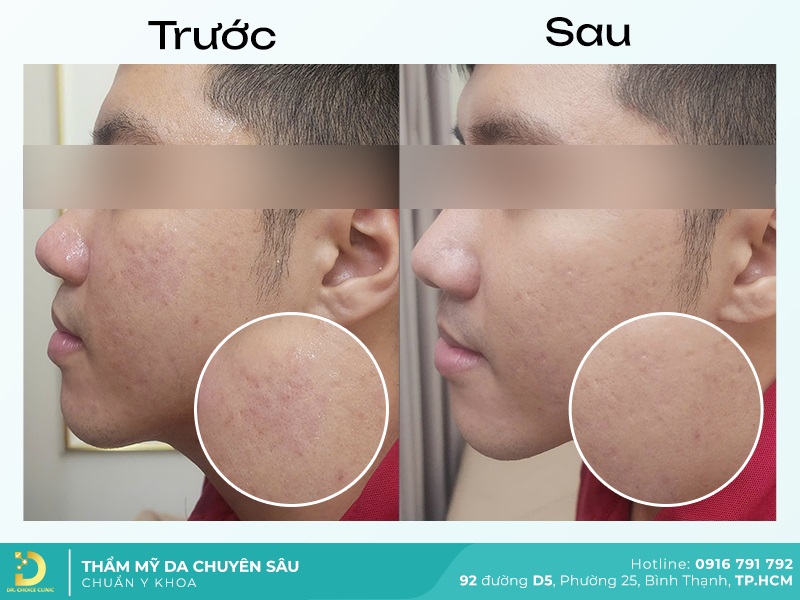 Lấy Nhân Mụn An Toàn, Hiệu Quả Chuẩn Y Khoa Tại TP.HCM 22 hinh anh ket qua lay nhan mun tai dr choice 2