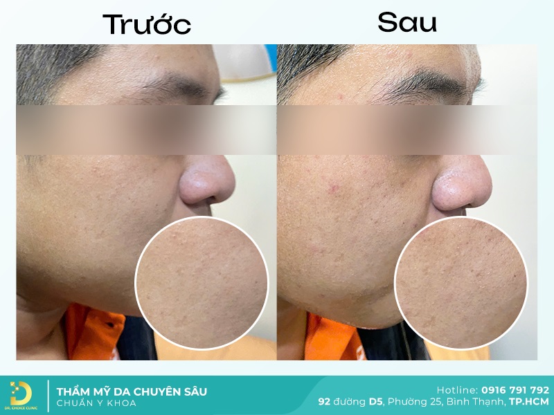 Lấy Nhân Mụn An Toàn, Hiệu Quả Chuẩn Y Khoa Tại TP.HCM 21 hinh anh ket qua lay nhan mun tai dr choice 3