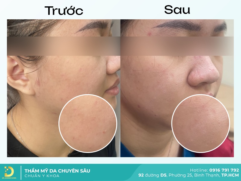 Lấy Nhân Mụn An Toàn, Hiệu Quả Chuẩn Y Khoa Tại TP.HCM 20 hinh anh ket qua lay nhan mun tai dr choice 4