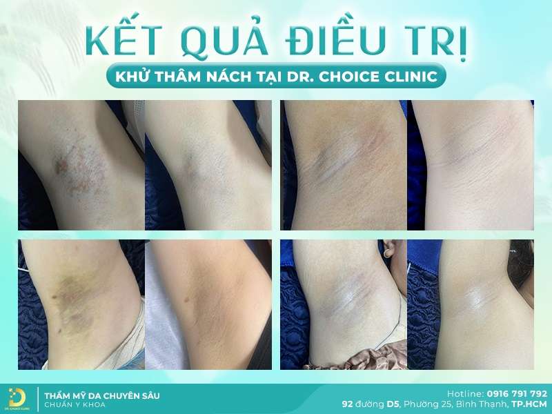 Dịch Vụ Chăm Sóc, Điều Trị, Thẩm Mỹ Da Chuẩn Y Khoa TP. HCM 42 Kết quả trị thâm nách.