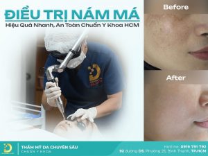 điều trị nám da