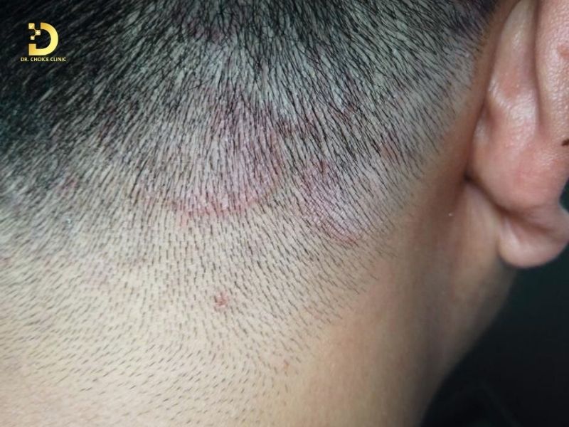 Phòng khám điều trị bệnh nấm da ở TPHCM hiệu quả, an toàn 10 Hình ảnh nấm da đầu