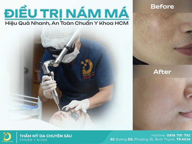 Phòng Khám Điều Trị Nám Má Hiệu Quả, An Toàn Ở HCM 17 điều trị nám má