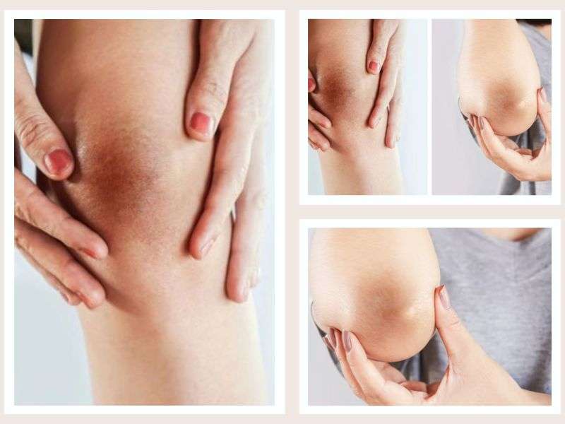 Phòng Khám Trị Thân Chân Tay Tại HCM An Toàn, Hiệu Quả 5 Nguyên nhân bị thâm chân, tay