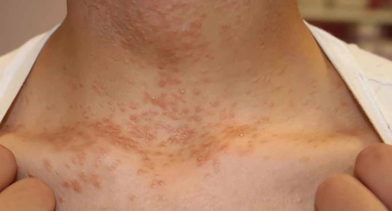 Phòng khám điều trị u tuyến mồ hôi an toàn, hiệu quả TPHCM 7 nguyen nhan u tuyen mo hoi