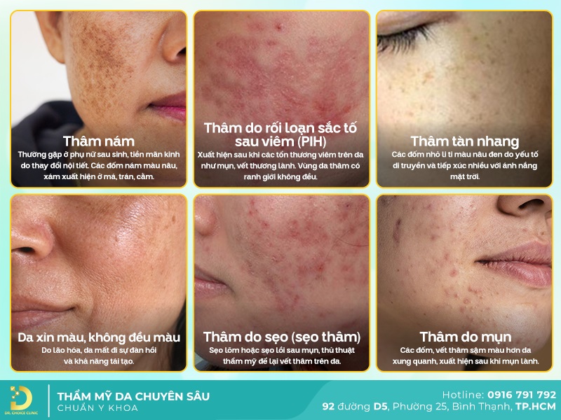 Phòng khám điều trị thâm mặt tại TPHCM chuẩn an toàn 10 Các dạng thâm mặt phổ biến