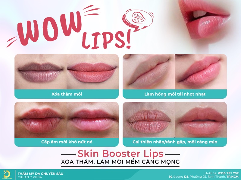 Phòng Khám Điều Trị Thâm Môi Tại HCM Đẹp Tự Nhiên 12 skin booster môi