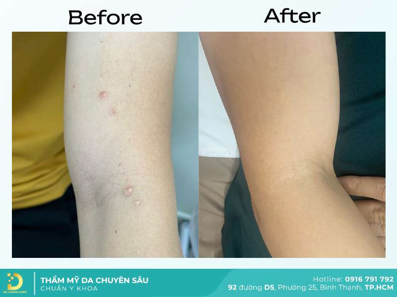 Dịch Vụ Chăm Sóc, Điều Trị, Thẩm Mỹ Da Chuẩn Y Khoa TP. HCM 46 Trị sẹo