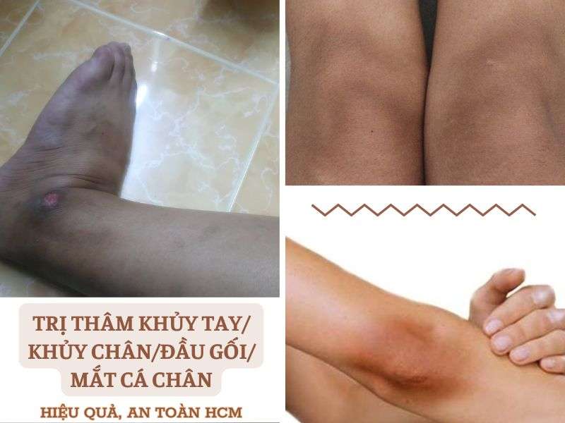 Phòng Khám Trị Thâm Khủy Tay Chân, Đầu Gối, Mắt Cá Chân HCM 4 Trị thâm khủy tay/khủy chân/đầu gối/mắt cá chân