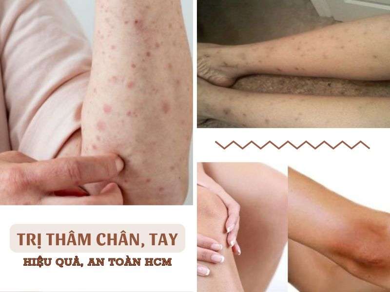 Phòng Khám Trị Thân Chân Tay Tại HCM An Toàn, Hiệu Quả 4 Trị thâm chân, tay
