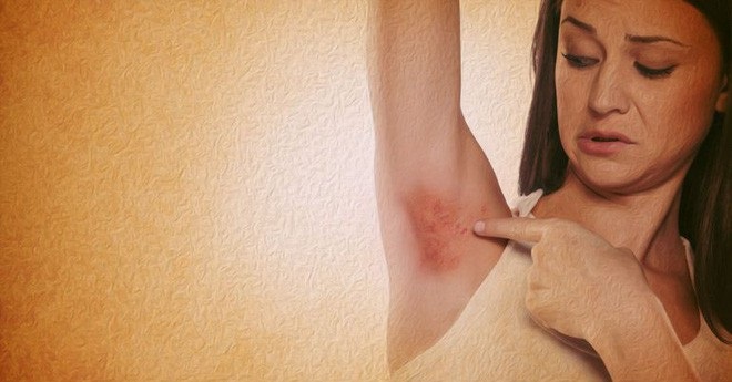 Phòng khám điều trị u tuyến mồ hôi an toàn, hiệu quả TPHCM 6 tri u tuyen mo hoi