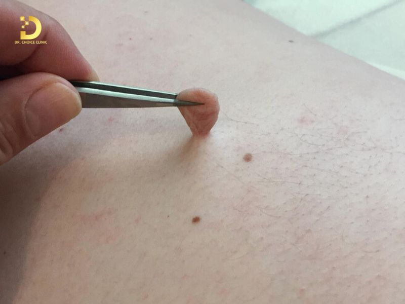 Phòng Khám Điều Trị U Treo Mềm An Toàn, Hiện Quả Ở TPHCM 8 Không nên tự cắt u mềm treo tại nhà