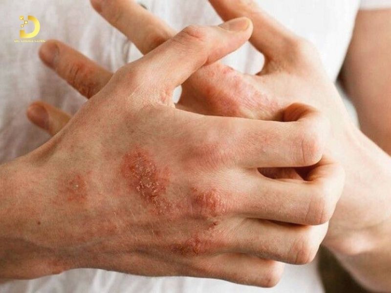 Phòng khám điều trị viêm da cơ địa (chàm) TPHCM uy tín 7 Viêm da cơ địa