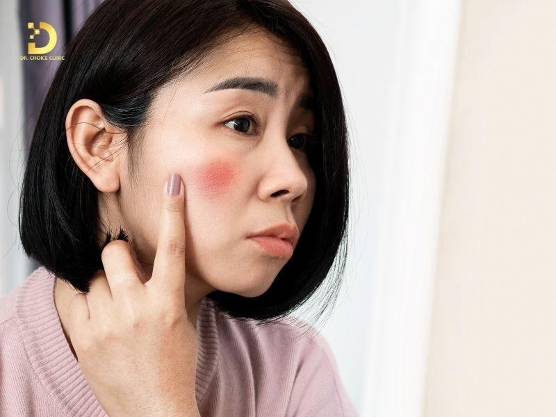 Phòng Khám Điều Trị Viêm Da Tiết Bã Chuẩn Y Khoa Tại HCM 8 Viêm da tiết bã