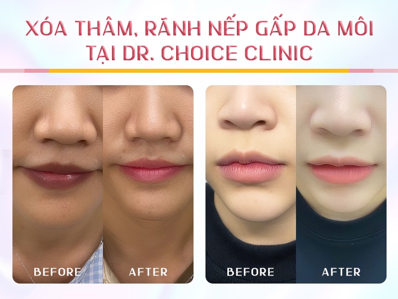 Phòng Khám Điều Trị Thâm Môi Tại HCM Đẹp Tự Nhiên 13 xóa thâm môi