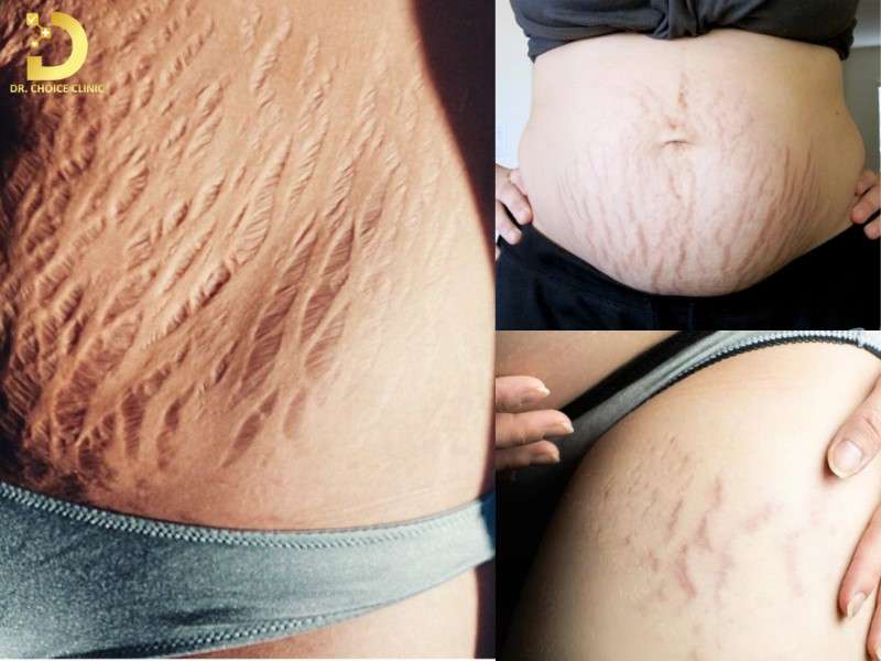 Rạn Da Là Gì? Nguyên Nhân, Cách Điều Trị & Phòng Ngừa Hiệu Quả 9 Nguyên nhân gây rạn da