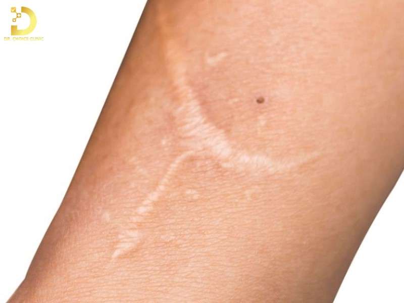Sẹo Trắng: Đặc Điểm, Nguyên Nhân, Các Loại & Cách Điều Trị 9 Nguyên nhân phổ biến gây sẹo trắng