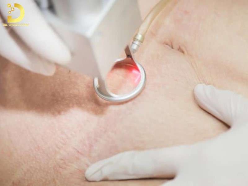 Rạn Da Là Gì? Nguyên Nhân, Cách Điều Trị & Phòng Ngừa Hiệu Quả 10 Điều trị rạn da