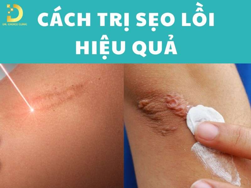Sẹo Lồi: Đặc Điểm, Nguyên Nhân, Các Loại & Cách Điều Trị 11 Trị sẹo lồi