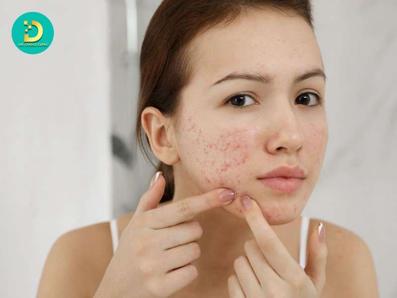 Sẹo Đáy Tròn: Đặc Điểm, Nguyên Nhân Và Phương Pháp Điều Trị Hiệu Quả 14 Cơ chế hình thành sẹo đáy tròn từ mụn trứng cá