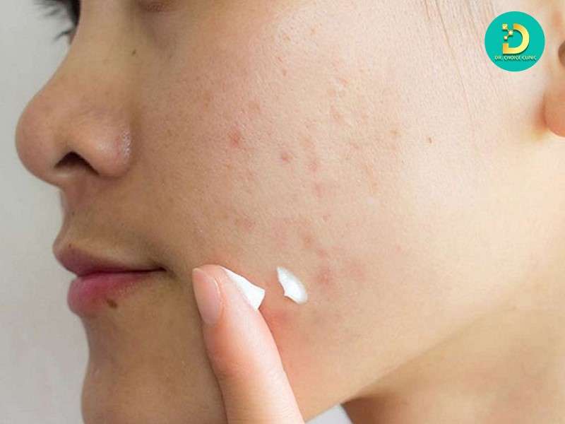 Sẹo Đáy Tròn: Đặc Điểm, Nguyên Nhân Và Phương Pháp Điều Trị Hiệu Quả 17 Điều trị sẹo tại chỗ