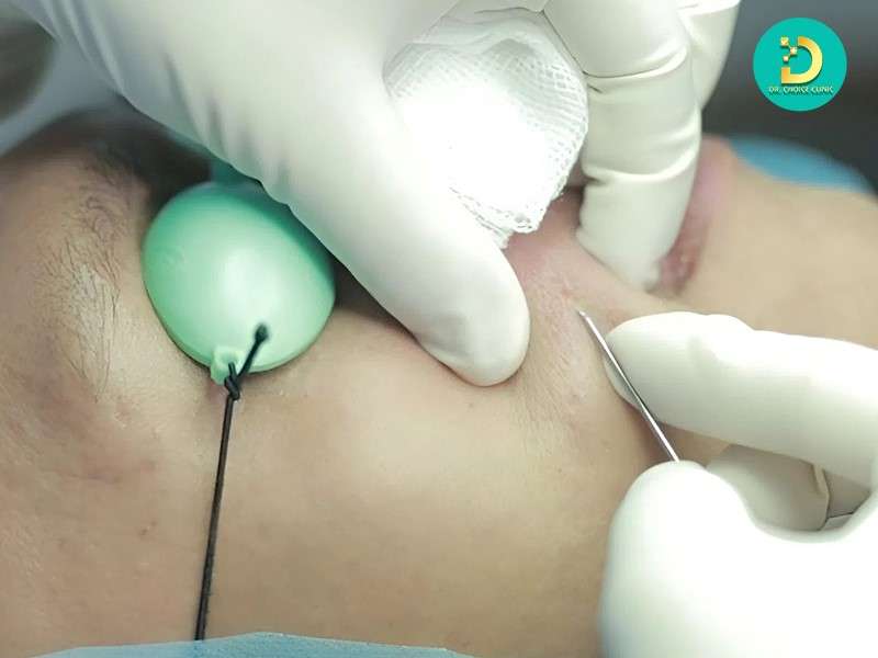 Sẹo Đáy Tròn: Đặc Điểm, Nguyên Nhân Và Phương Pháp Điều Trị Hiệu Quả 18 Điều trị sẹo xâm lấn
