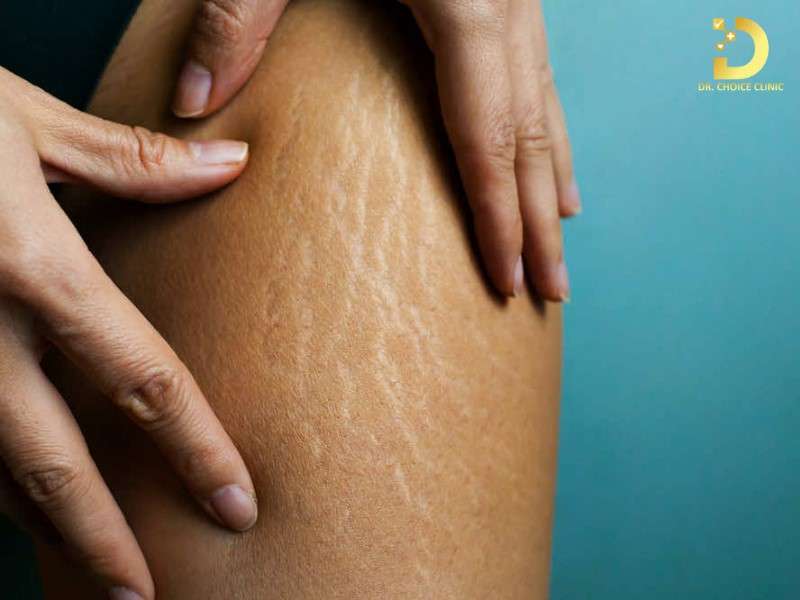 Rạn Da Là Gì? Nguyên Nhân, Cách Điều Trị & Phòng Ngừa Hiệu Quả 8 Hiểu rõ hơn về rạn da là gì