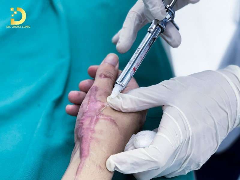 Tiêm Sẹo Lồi: Đặc Điểm, Công Dụng, Các Loại Và Lưu Ý Điều Trị 12 Khi tiêm sẹo lồi cần lưu ý