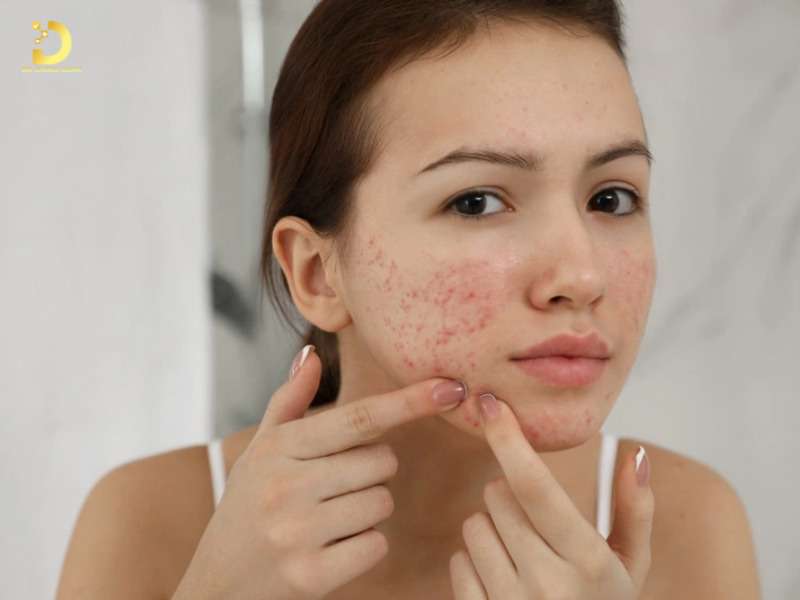 Sẹo Đáy Nhọn: Đặc Điểm, Nguyên Nhân & Cách Điều Trị Hiệu Quả 9 Mụn trứng cá viêm nặng là nguyên nhân hàng đầu gây sẹo đáy nhọn