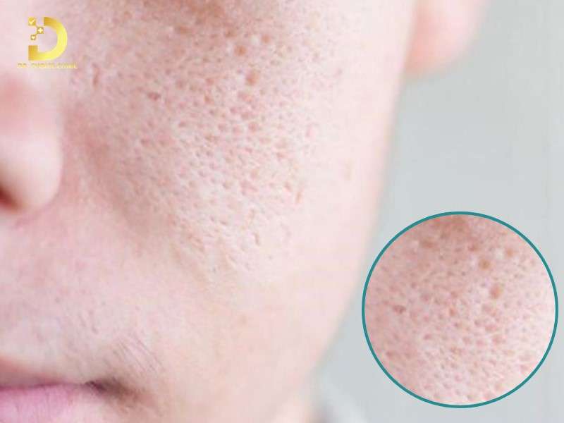 Sẹo Đáy Vuông: Đặc Điểm, Nguyên Nhân & Cách Điều Trị Hiệu Quả Nhất 9 Nguyên nhân gây ra sẹo đáy vuông là gì