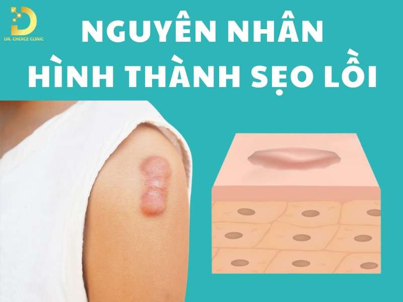 Sẹo Lồi: Đặc Điểm, Nguyên Nhân, Các Loại & Cách Điều Trị 9 Nguyên nhân hình thành sẹo lồi