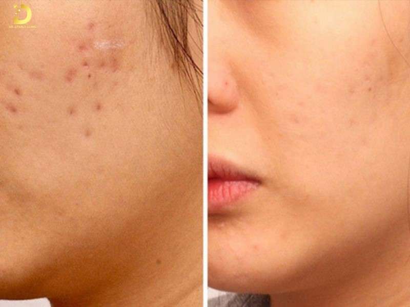Sẹo Lõm Do Thủy Đậu Có Tự Hết Không? Cách Điều Trị Hiệu Quả 10 Những yếu tố ảnh hưởng đến khả năng tự phục hồi sẹo lõm sau thủy đậu là gì