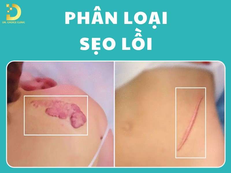 Sẹo Lồi: Đặc Điểm, Nguyên Nhân, Các Loại & Cách Điều Trị 10 Phân loại sẹo lồi