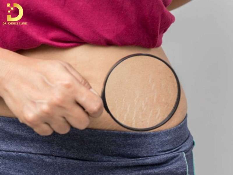 Rạn Da Là Gì? Nguyên Nhân, Cách Điều Trị & Phòng Ngừa Hiệu Quả 11 Phòng ngừa rạn da