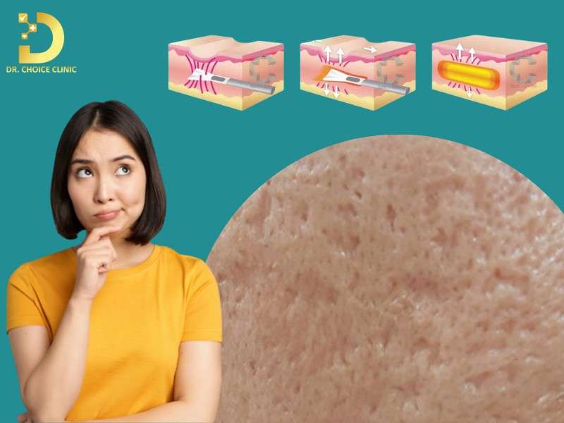 Sẹo Đáy Vuông: Đặc Điểm, Nguyên Nhân & Cách Điều Trị Hiệu Quả Nhất 10 Các phương pháp điều trị sẹo đáy vuông