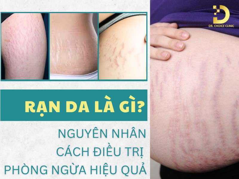 Rạn Da Là Gì? Nguyên Nhân, Cách Điều Trị & Phòng Ngừa Hiệu Quả 7 Rạn da là gì?