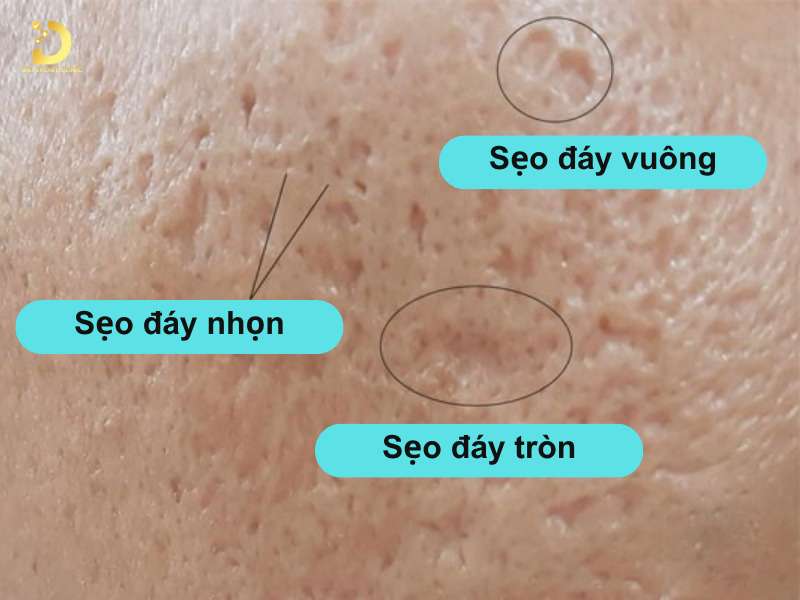 Sẹo Đáy Nhọn: Đặc Điểm, Nguyên Nhân & Cách Điều Trị Hiệu Quả 8 Sẹo đáy nhọn là gì?