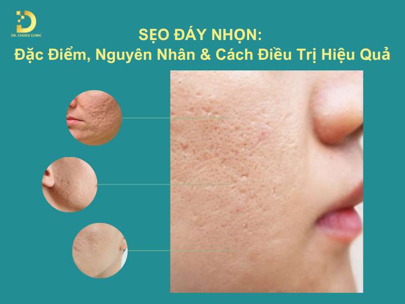 Sẹo Đáy Nhọn: Đặc Điểm, Nguyên Nhân & Cách Điều Trị Hiệu Quả 7 Sẹo đáy nhọn