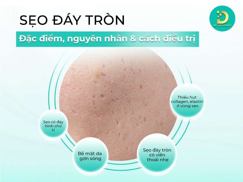 Sẹo Đáy Tròn: Đặc Điểm, Nguyên Nhân Và Phương Pháp Điều Trị Hiệu Quả 11 Sẹo đáy tròn