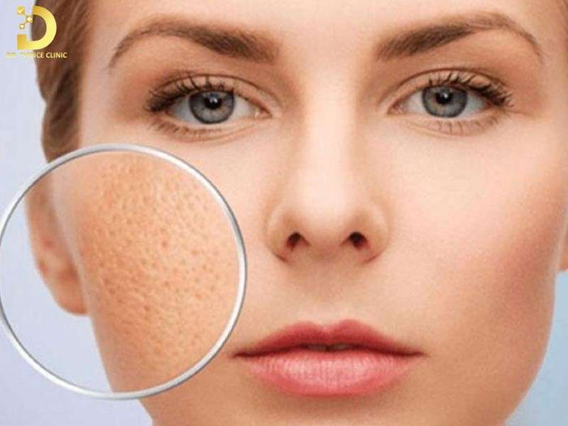 Sẹo Đáy Vuông: Đặc Điểm, Nguyên Nhân & Cách Điều Trị Hiệu Quả Nhất 8 Hiểu hơn về sẹo đáy vuông là gì