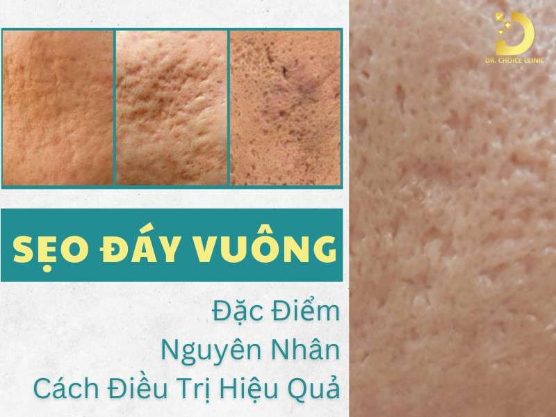 Sẹo Đáy Vuông: Đặc Điểm, Nguyên Nhân & Cách Điều Trị Hiệu Quả Nhất 7 Sẹo đáy vuông