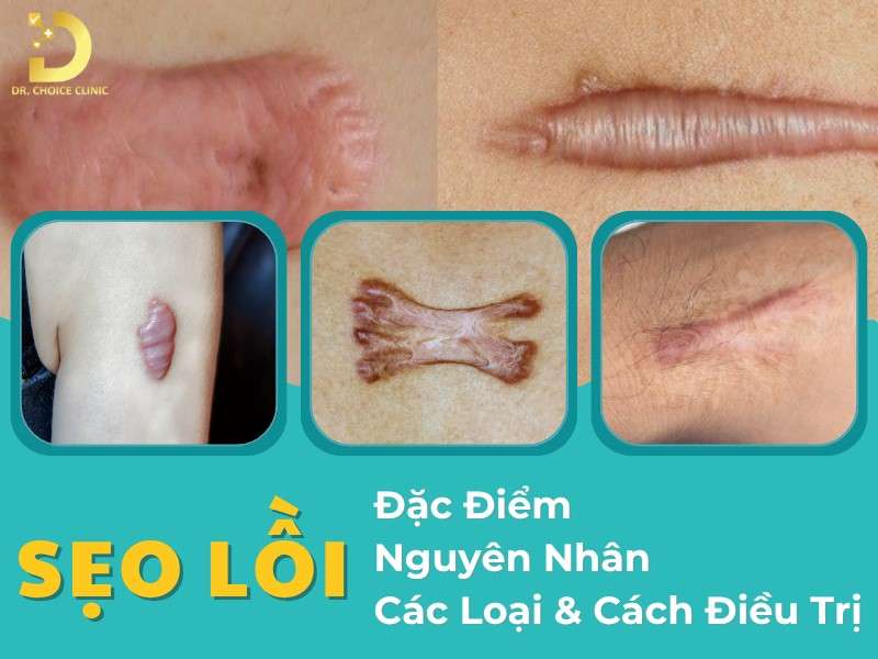 Sẹo Lồi: Đặc Điểm, Nguyên Nhân, Các Loại & Cách Điều Trị 7 Sẹo lồi