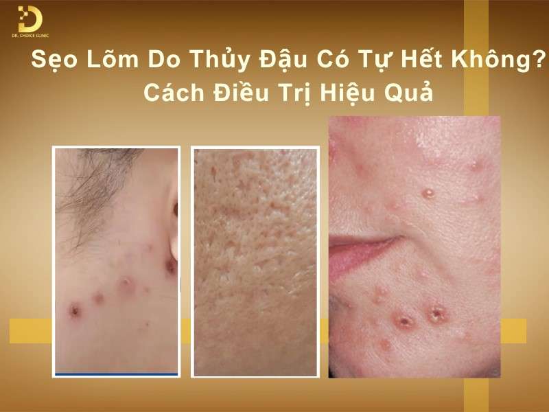 Sẹo Lõm Do Thủy Đậu Có Tự Hết Không? Cách Điều Trị Hiệu Quả 8 Sẹo lõm do thủy đậu có tự hết không?
