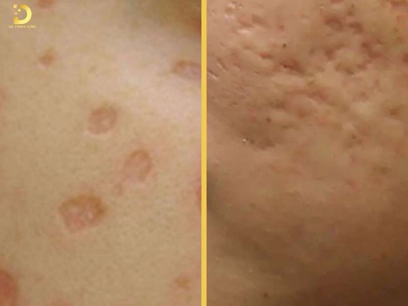 Sẹo Lõm Do Thủy Đậu Có Tự Hết Không? Cách Điều Trị Hiệu Quả 9 Sẹo lõm thủy đậu