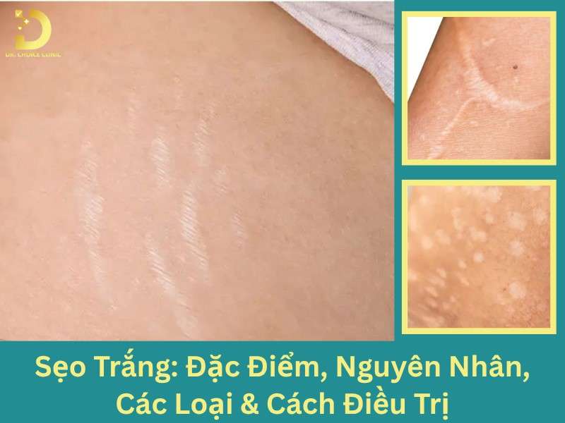 Sẹo Trắng: Đặc Điểm, Nguyên Nhân, Các Loại & Cách Điều Trị 7 Sẹo trắng