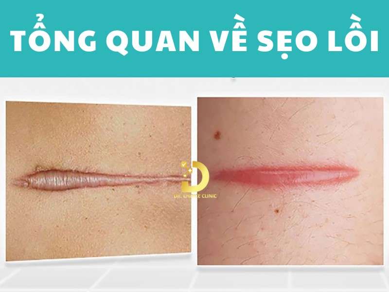Sẹo Lồi: Đặc Điểm, Nguyên Nhân, Các Loại & Cách Điều Trị 8 Tổng quan về sẹo lồi là gì