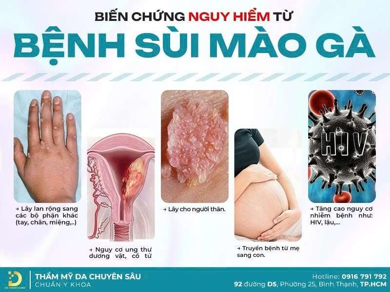 Phòng Khám Điều Trị Sùi Mào Gà Bảo Mật, An Toàn Tại TPHCM 14 Biến chứng của sùi mào gà