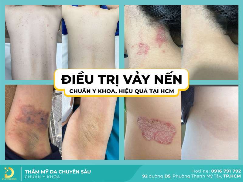 Phòng Khám Điều Trị Vảy Nến An Toàn, Hiệu Quả Tại TPHCM 9 Các phương pháp điều trị vảy nến theo chuẩn y khoa