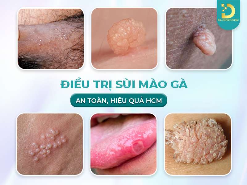 Phòng Khám Điều Trị Sùi Mào Gà Bảo Mật, An Toàn Tại TPHCM 11 Điều trị sùi mào gà