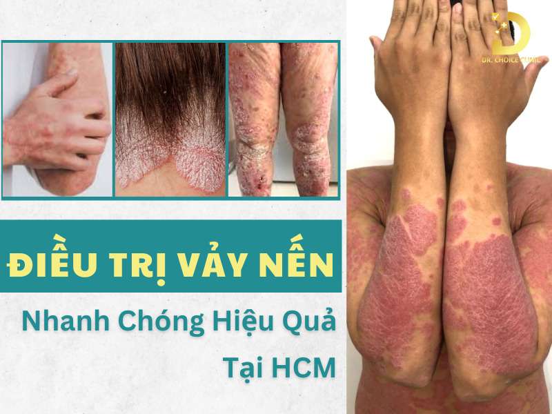Phòng Khám Điều Trị Vảy Nến An Toàn, Hiệu Quả Tại TPHCM 7 Điều trị vảy nến